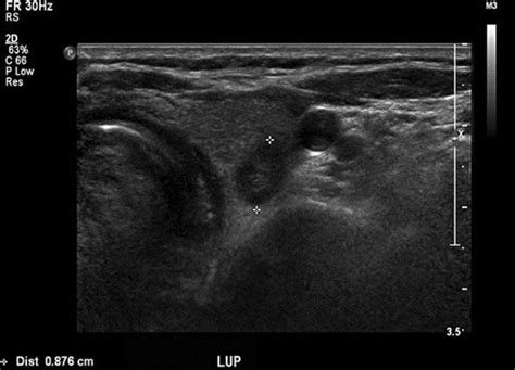 Thyroid Ultrasound Finding Diffuse Heterogenous Low Echogenicity Of