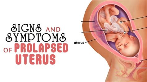 Signs And Symptoms Of Prolapsed Uterus Youtube