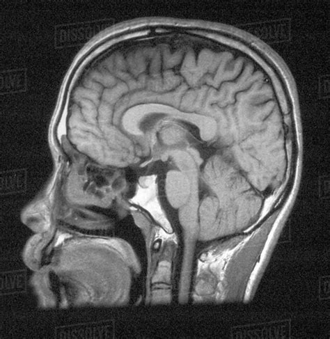 Mri Of Head Showing Normal Brain Structures Stock Photo Dissolve