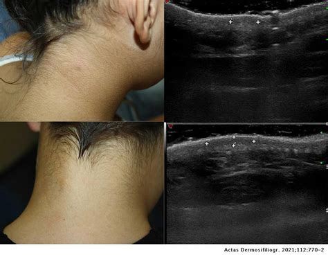 Clinical And Ultrasound Features Of Dermatofibromas In Pediatric