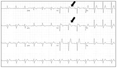 Brugada Syndrome Coinciding With Fever And Pandemic H1n1 Influenza Cmaj