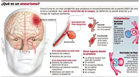 Aneurisma O Aneurysm Tipos Causas S Ntomas Y Tratamientos