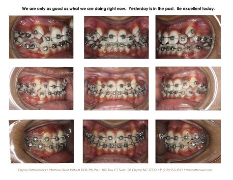 First for young patients · effective aligners · indivudual treatment Crowding Non-Extraction Treatment Photos | Orthodontics