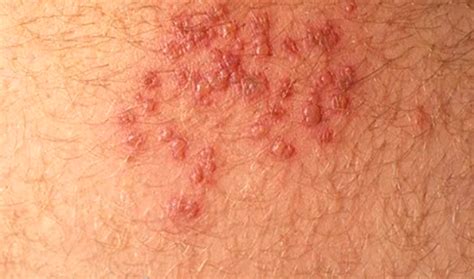 Hiv Rash Images Symptoms Location And Treatment Hubpages
