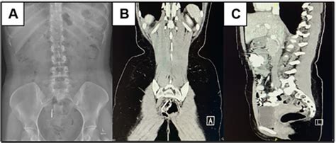 Findings On Imaging A Abdominal X Ray Showing An Iud Within The