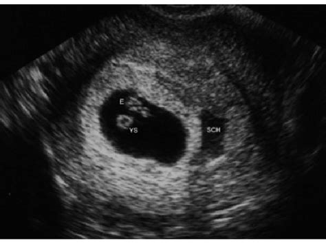 Subchorionic Hemorrhage Sch Appears As A Sonolucent Area Adjacent To