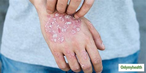 Experiencing Palm Rashes Heres Are Some Treatment Tips From