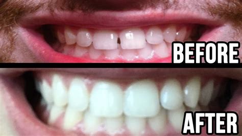 It just depends close the gap for any missing teeth. Fixed My Teeth Gap Without Braces! 45MIN WORK! - YouTube
