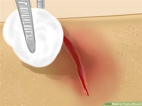 How To Treat A Wound 10 Steps With Pictures Wikihow