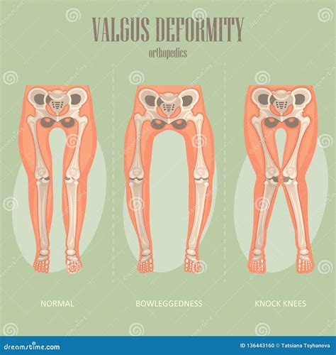 Valgus Deformity Vector Medical Poster Stock Vector Illustration Of