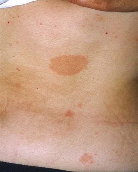 Pityriasis Rosea Causes Rash Herald Patch Stages Treatment