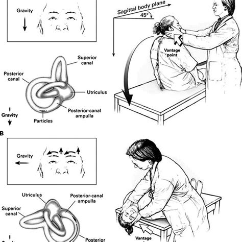The Semont Maneuver For Right Sided Bppv 1 Patient Is Seated In The