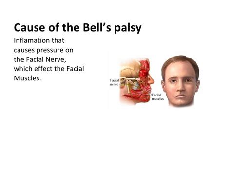 Bells Palsy Causes Symptoms And Treatment Ucsf Ahp Org
