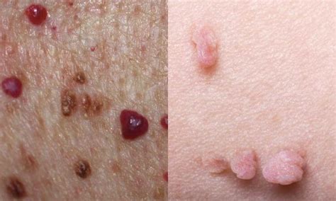 Raised Skin Bumps Types Causes And Treatment Kfanhub