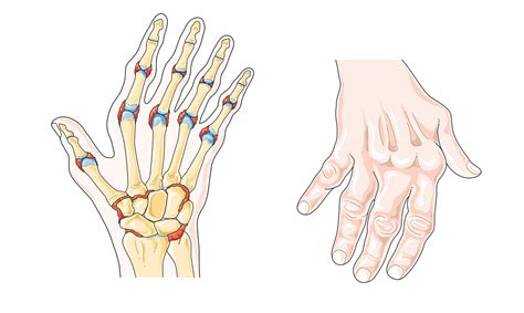 Living with rheumatoid arthritis (ra) requires more than just finding the right medications. Symptoms and treatment of rheumatoid arthritis | General ...