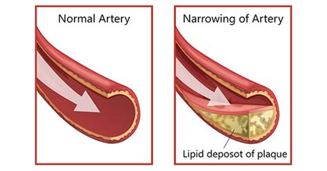 What Is Coronary Artery Disease And How Does It Develop Cusabio