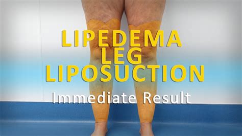 Lipedema Leg Liposuction Surgery Results Lipo 360° Legs Cankles