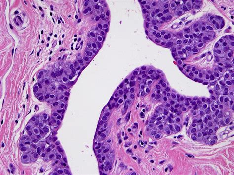 Lobular Carcinoma In Situ Classical Type And Unusual Variants Surgical Pathology Clinics