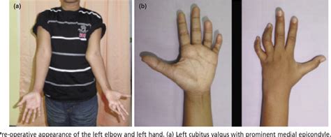 Figure 1 From Cubitus Valgus With Tardy Ulnar Nerve Palsy Is Anterior