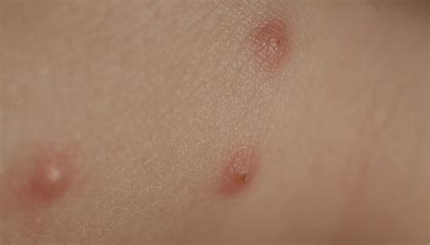 Identifying Common Insect Bites And Stings Sentinel Blog 2022