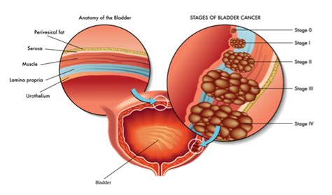 Transurethral Resection Of The Bladder Tumor Turbt Flagstaff Az