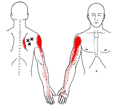 Infraspinatus Trigger Points And Referred Pain
