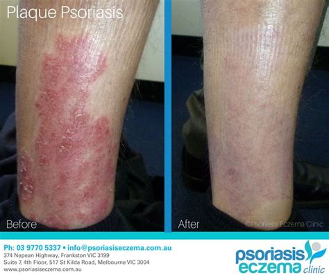 Plaque Psoriasis Before And After Results At The Psoriasis Eczema