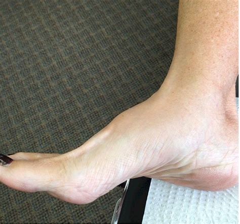 Arthritis Of The Foot And Ankle Causes And Treatment Options