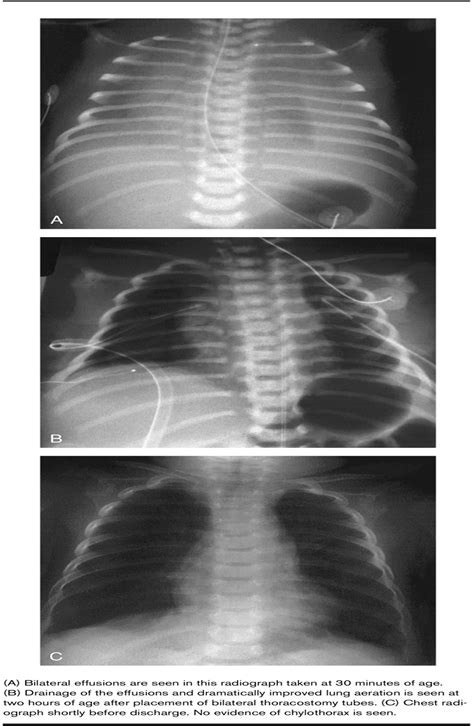 Congenital Chylothorax Current Opinion In Pediatrics