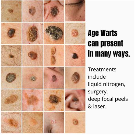 Age Warts Seborrhoeic Keratosis Dr Davin Lim