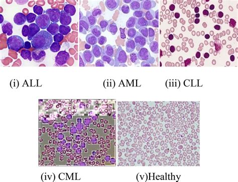 Different Types Of Leukemia I Acute Lymphocytic Leukemia Ii Acute