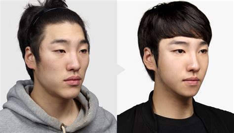 celebrity male plastic surgery before and after photos 016