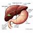Bile Duct Cancer Frequently Asked Questions  Health Encyclopedia