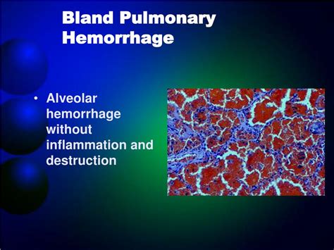 Ppt Diagnosis In Diffuse Alveolar Hemorrhages Powerpoint Presentation