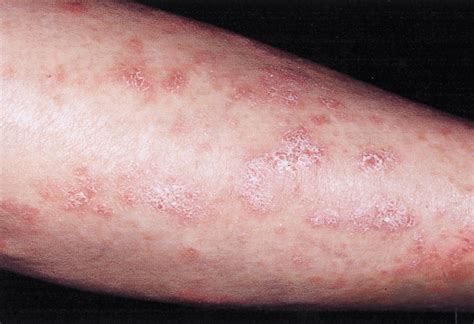 Frequency And Severity Of Systemic Disease In Patients With Subacute Cutaneous Lupus