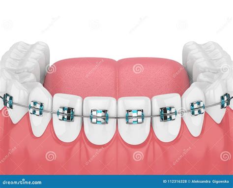 Orthodontic Braces Banner With Teeth Characters Cartoon Vector 123217165
