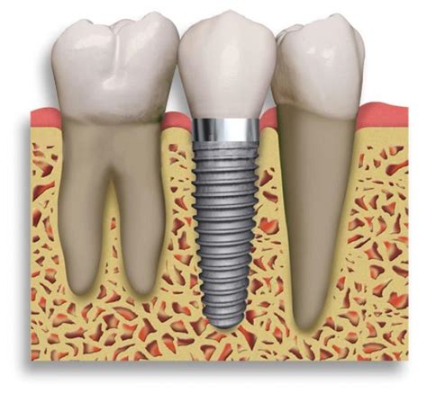 Implante Dental Clínica Dental Baldrich