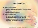 Pictures of Hiatal Hernia Diagnosis And Treatment
