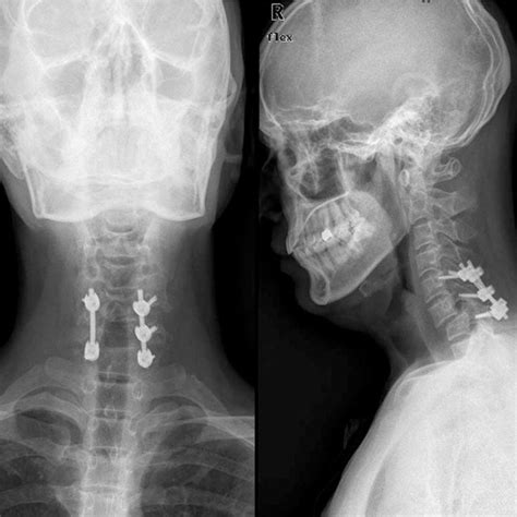 Preoperative Anteroposterior And Lateral X Rays Revealed Redislocation