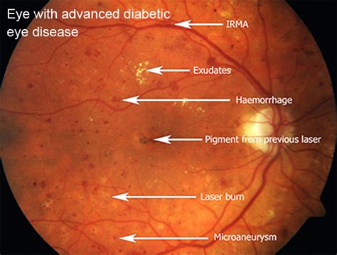 Fundus 2 Specsure Opticians