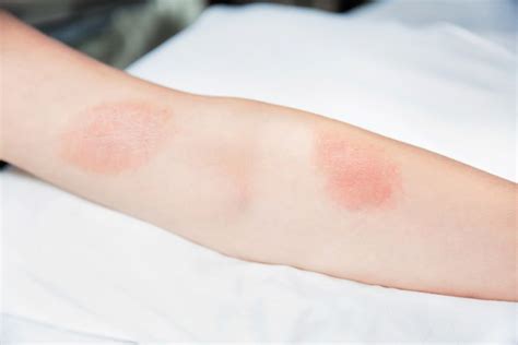 Itchy Bumps Filled With Clear Liquid Causes And Treatment