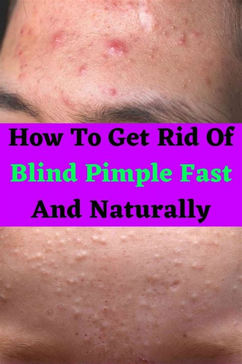 How To Get Rid Of Blind Pimple Fast And Naturally In 2021 Blind