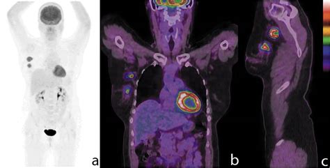 Figure 1 Evaluation Of The Usefulness Of Fdg Petct For Nodal