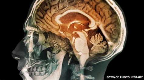 Alcohol Related Brain Damage Report Highlights Concerns Bbc News