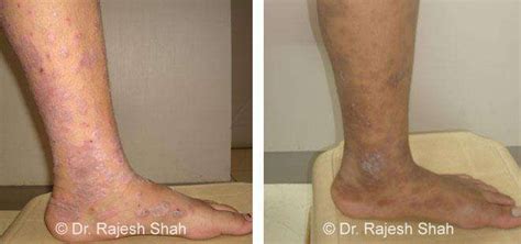 Patient Treatment Photos From Life Force Homeopathic Clinics
