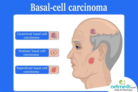 Basal Cell Carcinoma Causes Symptoms And Treatment Netmeds