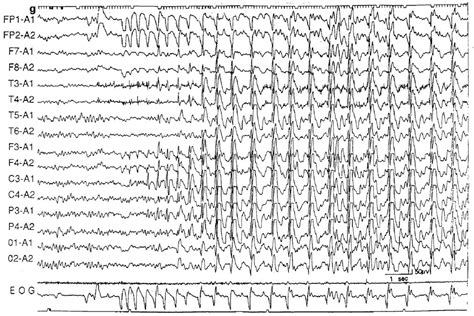 Blink Induced Centrotemporal Spikes In Benign Childhood Epilepsy With