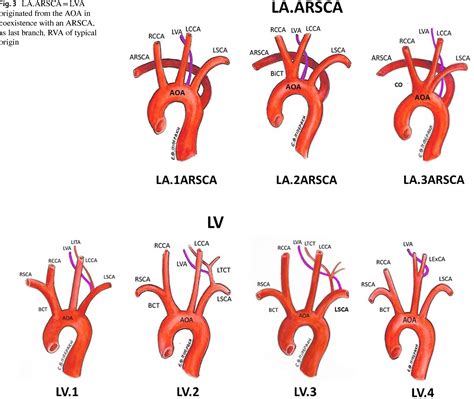 Figure 3 From A Systematic Classification Of The Vertebral Artery