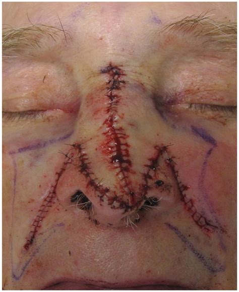 Post Nasal Reconstruction Displaying The Bilateral Malar Transposition