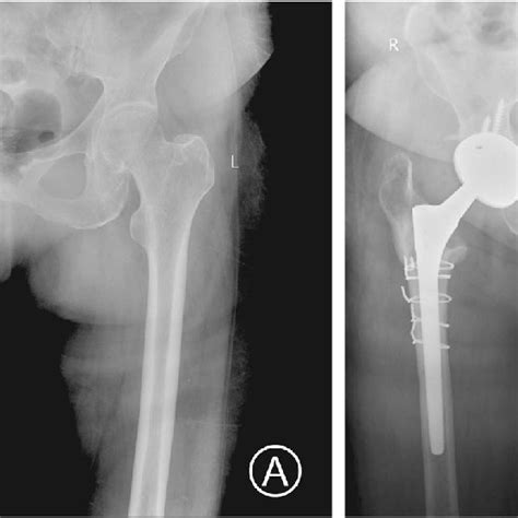 dislocation occurred six months after total hip replacement a which download scientific